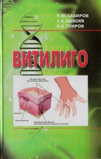 Vitiligo