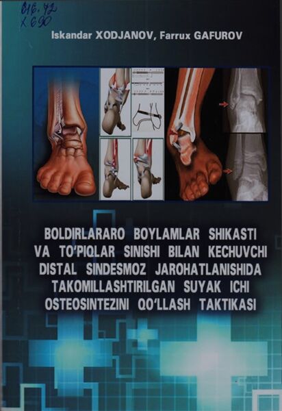 Boldirlararo boylamlar shikasti va to'piqlar sinishi bilan kechuvchi distal sindesmoz jarohatlanishida takomillashtirilgan suyak ichi osteosintezini qo'llash taktikasi.