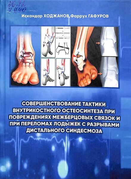 Совершенствование тактики внутрикостного остеосинтеза при  повреждениях межберцовых связок и  при переломах лодыжек с разрывами  дистального синдесмоза