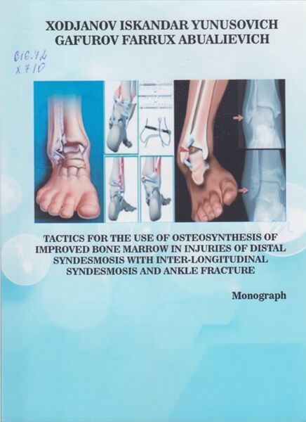 Tactics for the use of osteosynthesis of improved bone marrow in injuries of distal syndesmosis with inter¬ longitudinal syndesmosis and ankle fracture