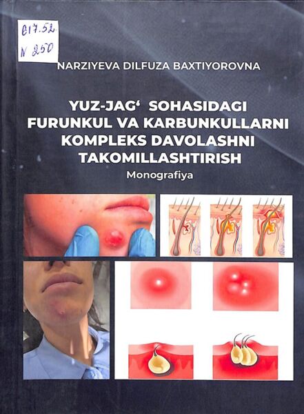 Yuz-jag‘ sohasidagi furunkul va karbunkullami kompleks davolashni takomillashtirish
