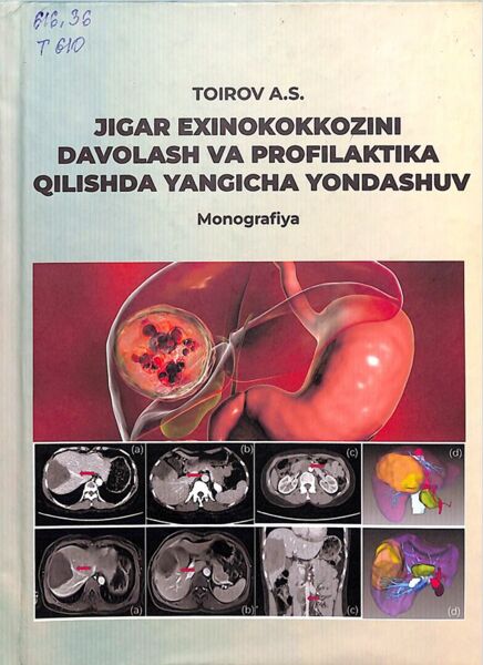 Jigar exinokokkozini davolash va profilaktika qilishda yangicha yondashuv 